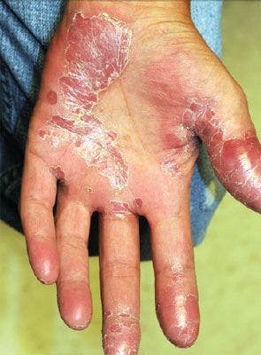 Skin Signs of HIV?