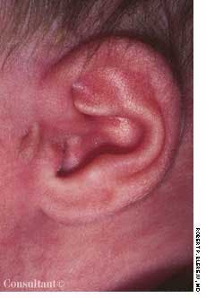 Accessory Tragus in an Infant Girl