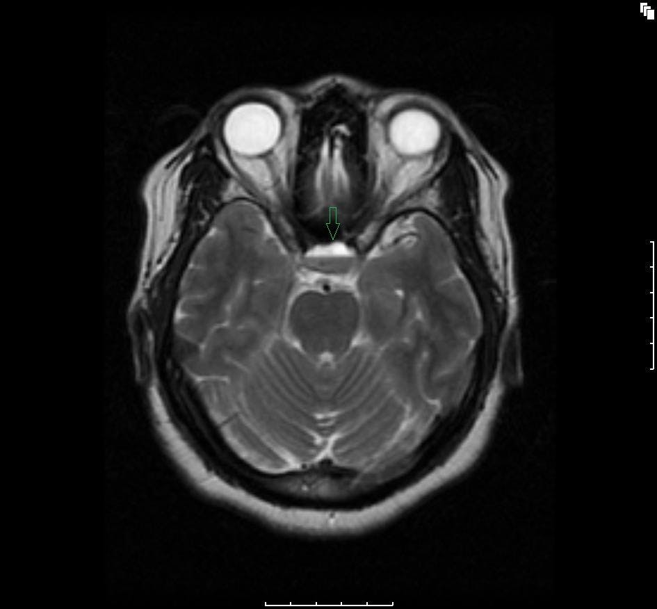 Hemorrhagic Pituitary Apoplexy in Pregnancy: A Retrospective Radiologic Diagnosis