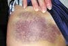 Bruising Caused by Acute Lymphocytic Leukemia