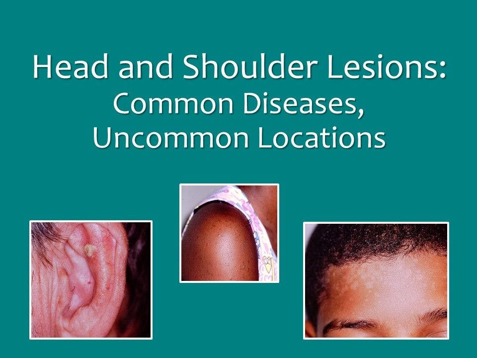 Head and Shoulder Lesions: Common Diseases, Uncommon Locations 