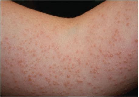 Intensely Pruritic Rash After Sun Exposure in a Tween Girl 