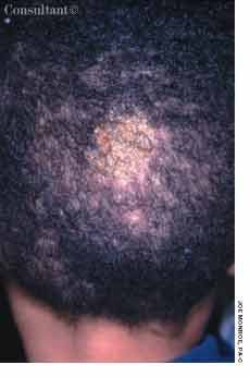 Tinea Capitis With Kerions