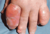 Gouty Arthritis: A Photo Essay