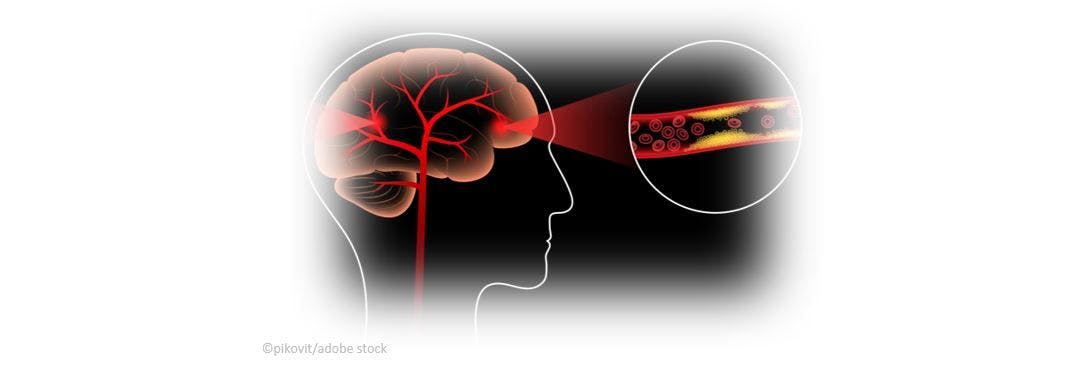 Stroke Patients Very Likely to Present with Undiagnosed Risk Factors
