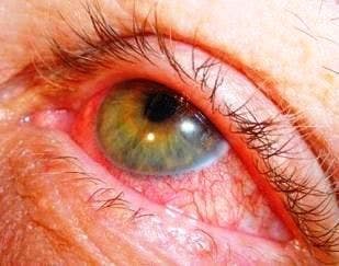 Ocular Disease: The Eyes Have It-A Photo Quiz