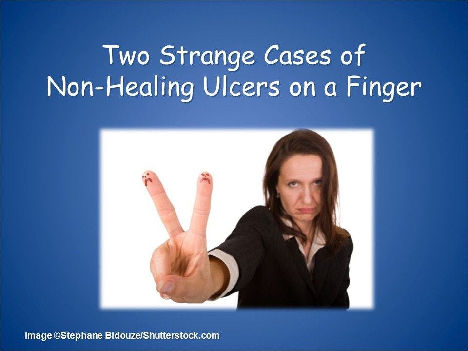 Non-Healing Finger Ulcers in 2 Teen Boys 