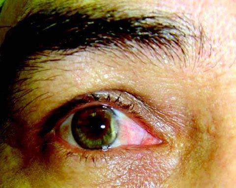 Middle-Aged Man With Wedge-Shaped Growths in Both Eyes