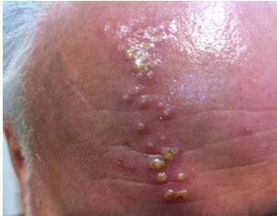 Fluid-Filled Blisters: Your Dx?