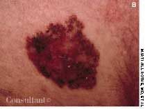 Pigmented Basal Cell Carcinoma on Buttocks of a 60-Year-Old Woman