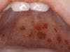 Palatal Petechiae in a Young Girl: What Cause? 