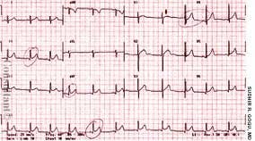 Acute Pericarditis in a Young Girl