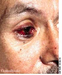 Kaposi's Sarcoma of the Eyelid in a Patient With AIDS