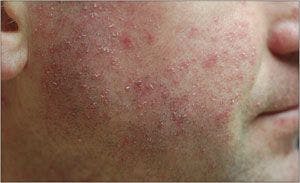 Is this scaly rash a drug reaction-or something else?