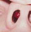 Nasal Hemangioma