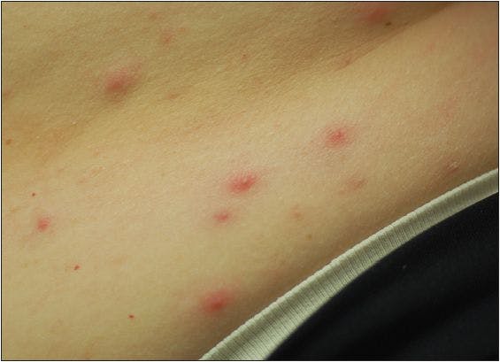 Is this asymptomatic eruption acne - or something else?