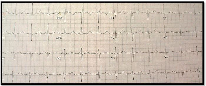 ECG Challenge: Palpitations and Syncope in a Young Man 