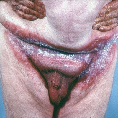 Can you identify this chronic malodorus rash?