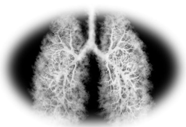 Dupilumab Reduces COPD Exacerbations for Patient with T2 Inflammation in Landmark Phase 3 Study  lungs ©pascalkphoto/stock.adobe.com