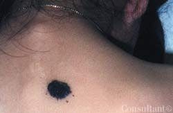 Congenital Melanocytic Nevus on Upper Back of a 5-Year-Old Girl 