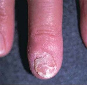 Deformed Fingernail