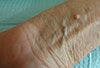 Actinic Keratosis in a 60-Year-Old Woman