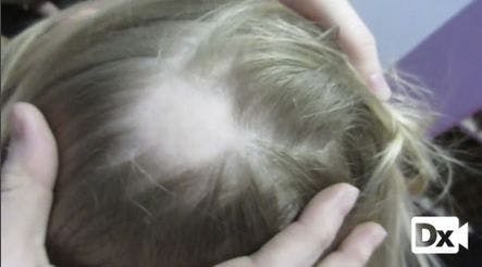 A Young Girl With Recurring Alopecia