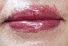 Allergic Reaction to Ingredient in Lipstick