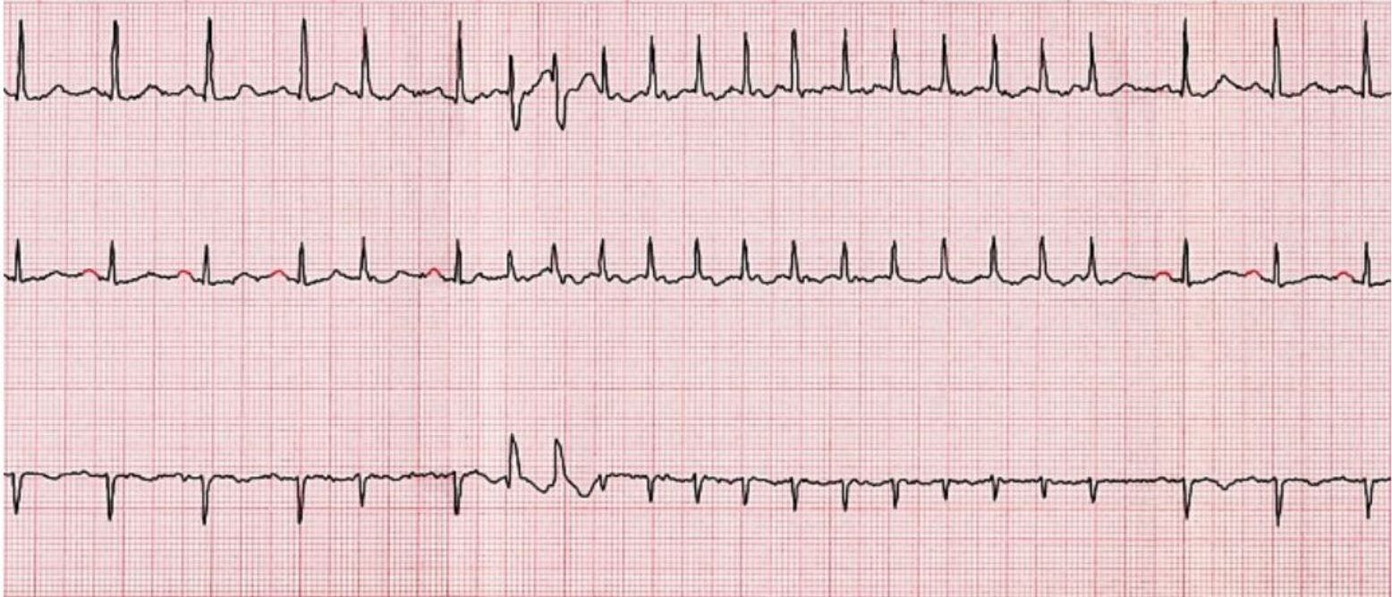 Novel Study Shows Decline in Atrial Fibrillation Deaths, but More Work Needed