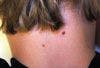 Can you identify this dark mole on a boy's neck?