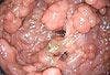 A Young Man With Thousands of Colorectal Polyps: Anomalous and Benign? Or, Something Else?