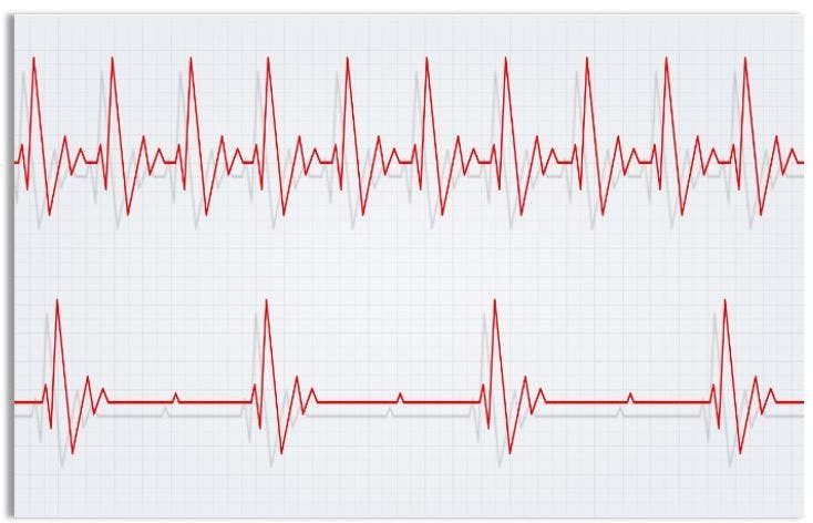 COVID-19 Cardiac Sequelae Include Prolonged Tachycardia, Analysis of Wearable Data Finds 