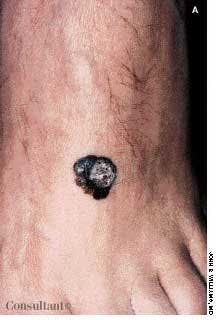 Melanoma of the Foot: Often Overlooked 