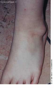 Peroneal Ganglion