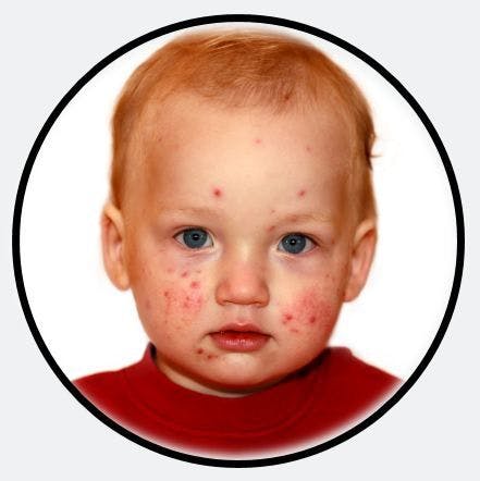 SPECIAL REPORT: Pediatric Vaccines 