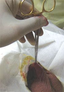 No-Scalpel Vasectomy