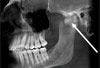 Incidental Finding in Man Referred for Dental Treatment of Snoring