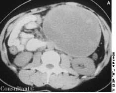 Papillary Cystic Neoplasm of the Pancreas