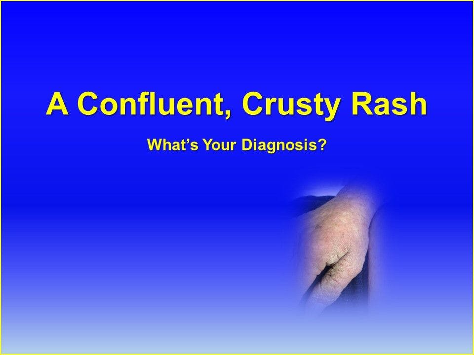 A Confluent, Crusty Rash
