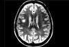 Multiple Sclerosis as Seen on MRI: A Photo Essay