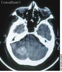 Cerebellar Hemorrhage in Woman With History of Hypertension