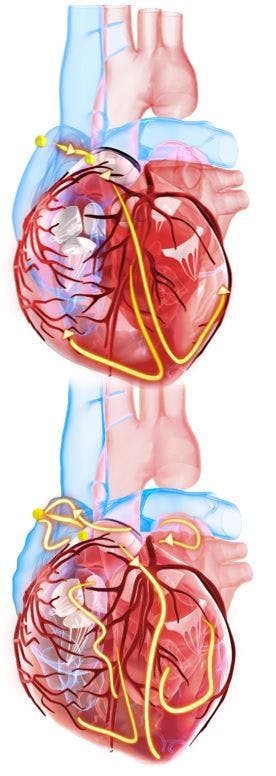 Phase 3 Trial of Factor XIa Inhibitor Asundexian Halted for Lack of Efficacy / image credit AFIB ©TuMeggy/stock.adobe.com