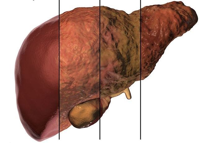 NAFLD Linked to Adverse Outcomes Regardless of BMI, Suggests New Research / image credit liver disease ©Kateryna_Kon/stock.adobe.com