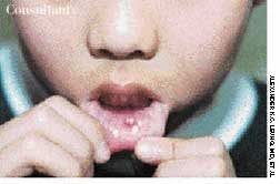 Mucocele: Excision to Prevent Recurrence 