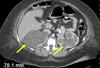 Autosomal Dominant Polycystic Kidney Disease in a 38-Year-Old Woman