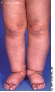 Myxedema in a 47-year-old Woman 