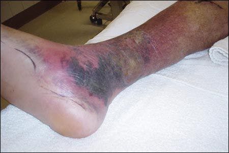 Injuries From Falls