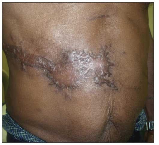 Keloid After Herpes Zoster in an HIV-Infected Person