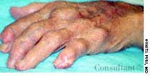 Chronic Tophaceous Gout in a 65-Year-Old Man