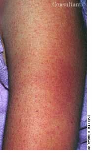 Keratosis Pilaris on the Upper Arms of a Teenager